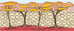 cellulitis hautschicht