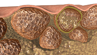 Hautoberschicht bei Cellulitis