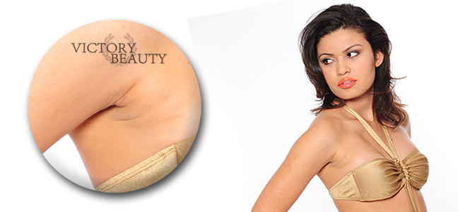 Definitive Haarentfernung