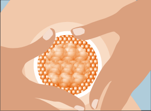 Erstmaliges Erkennen von Orangenhaut